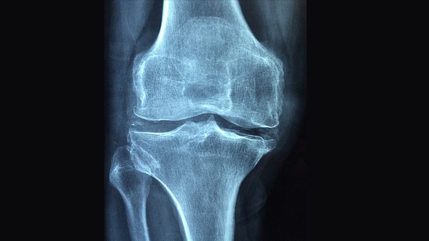 Romatizmal hastalıklar 'osteoporoz' riskini artırıyor