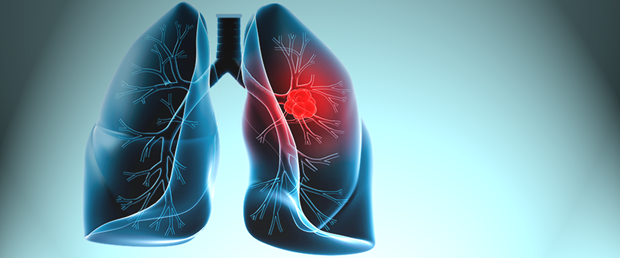 Akciğer kanserinde hedefe yönelik tedavi umudu