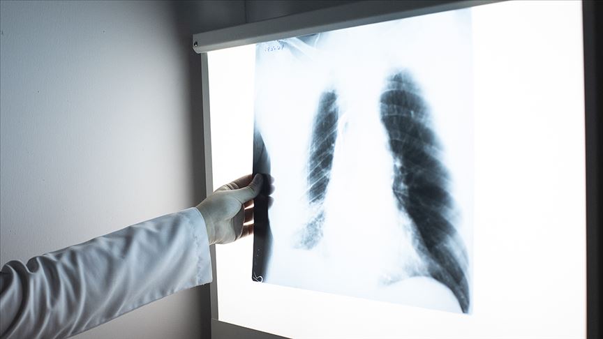Göğüs röntgeninden hastalık teşhisi yapay zekayla hızlanacak