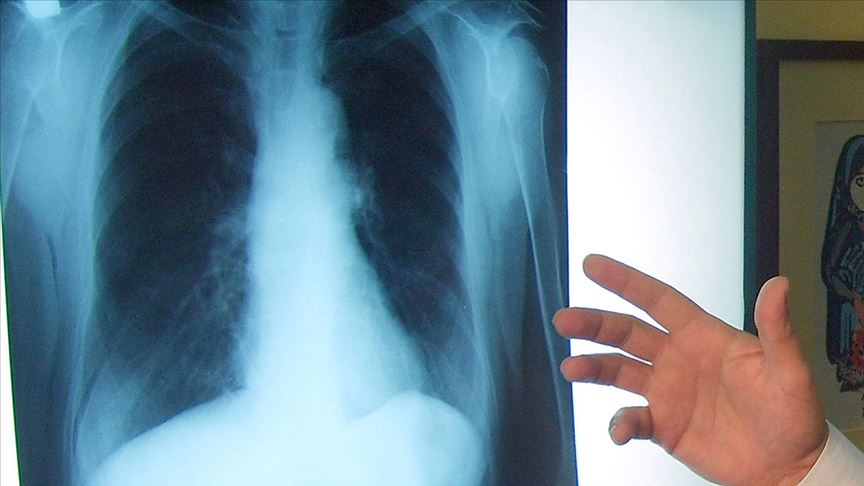 İmmüno-onkoloji ile akciğer kanseri tedavisi