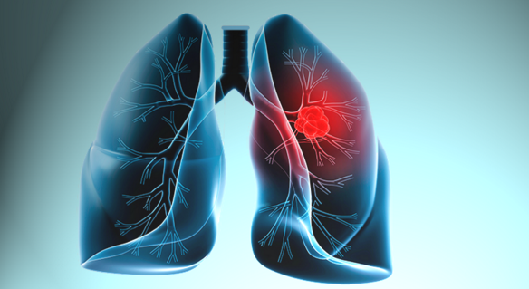 Türkiye'de her yıl 18 bin kişiye akciğer kanseri teşhisi konuluyor